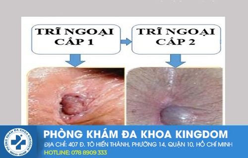 Trĩ ngoại cấp 1 