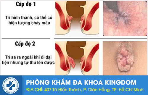 trĩ nội cấp 1, 2