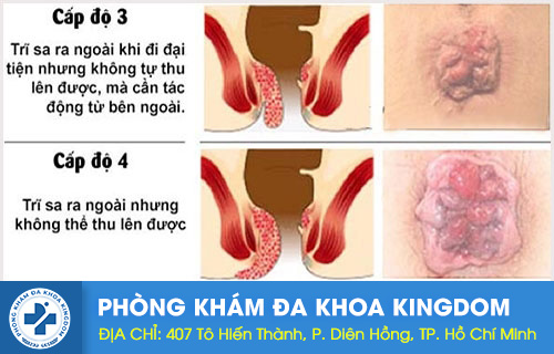 Trĩ nội cấp độ 3, 4