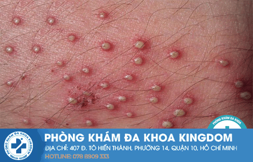 Dấu hiệu viêm nang lông